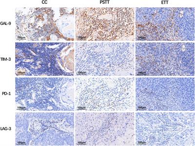Expression of the immune targets in tumor-infiltrating immunocytes of gestational trophoblastic neoplasia
